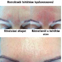 Homlokredő feltöltése hyaluronsavval