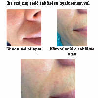 Orr szájzug redő feltöltése hyaluronsavval