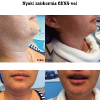 Nyaki zsírbontás GUNA-val