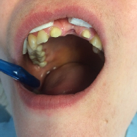 Baleset miatt eltávoíitott fog,előkészítés zirkon hidhoz