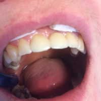 A kész hid beragasztása utan